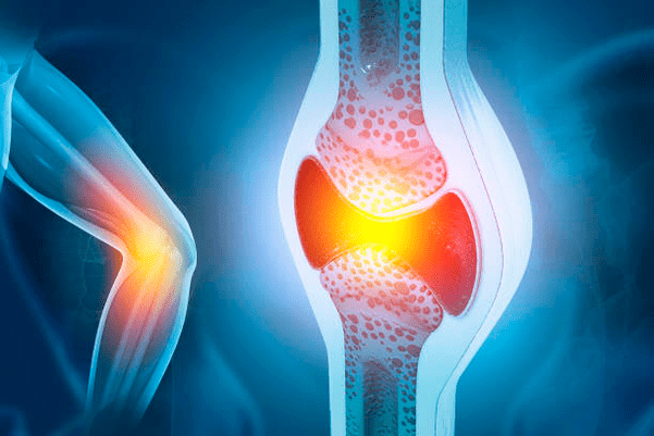 Locītavu slimību profilakse