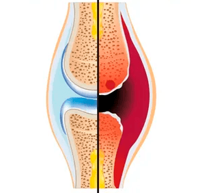 Veselas un nolietotas locītavas struktūra ar skrimšļa audu un sinoviālā šķidruma apzīmējumu